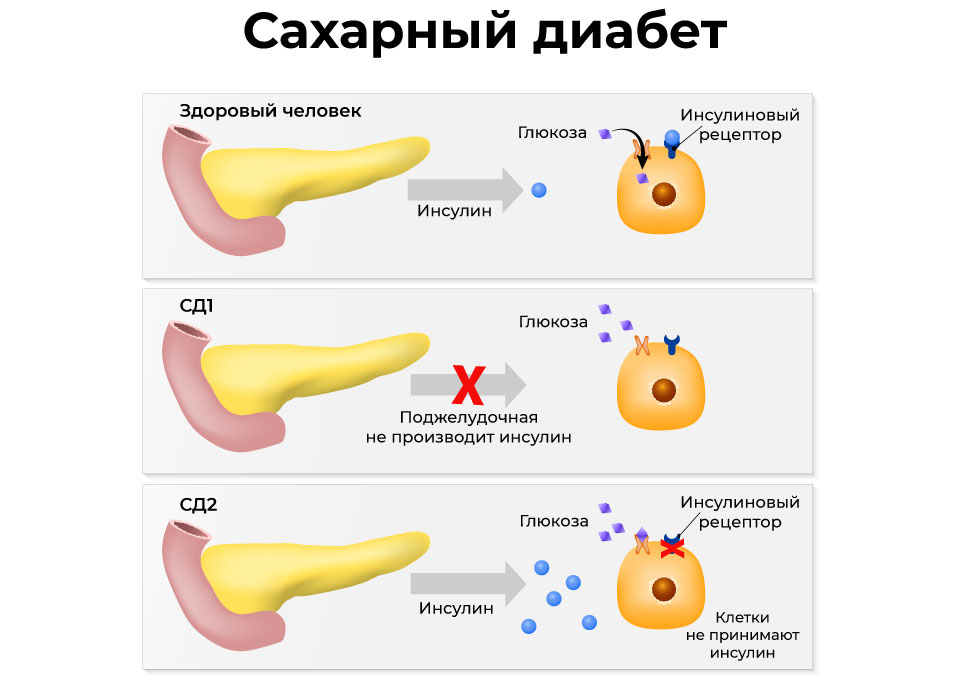 Работа поджелудочной железы и рецепторов клетки при сахарном диабете 1-го и 2-го типа